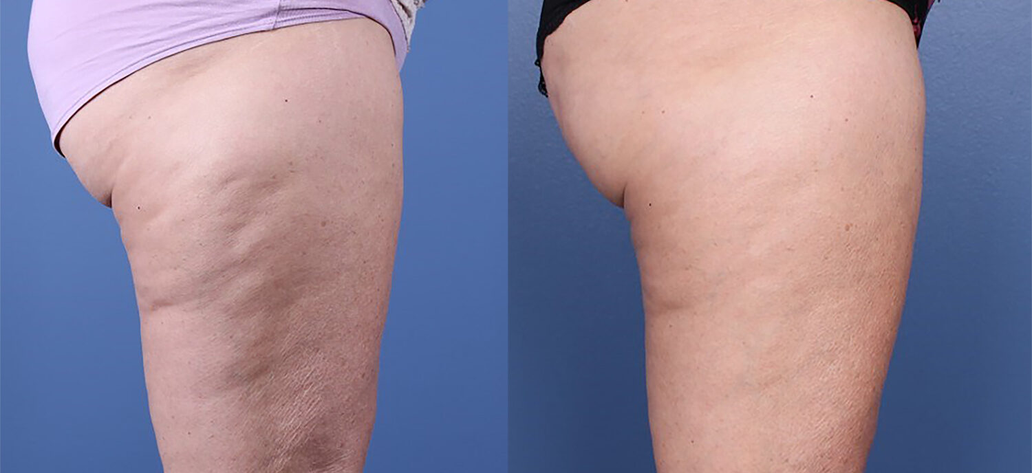 Morpheus8 laser treatment results on woman buttocks and leg area