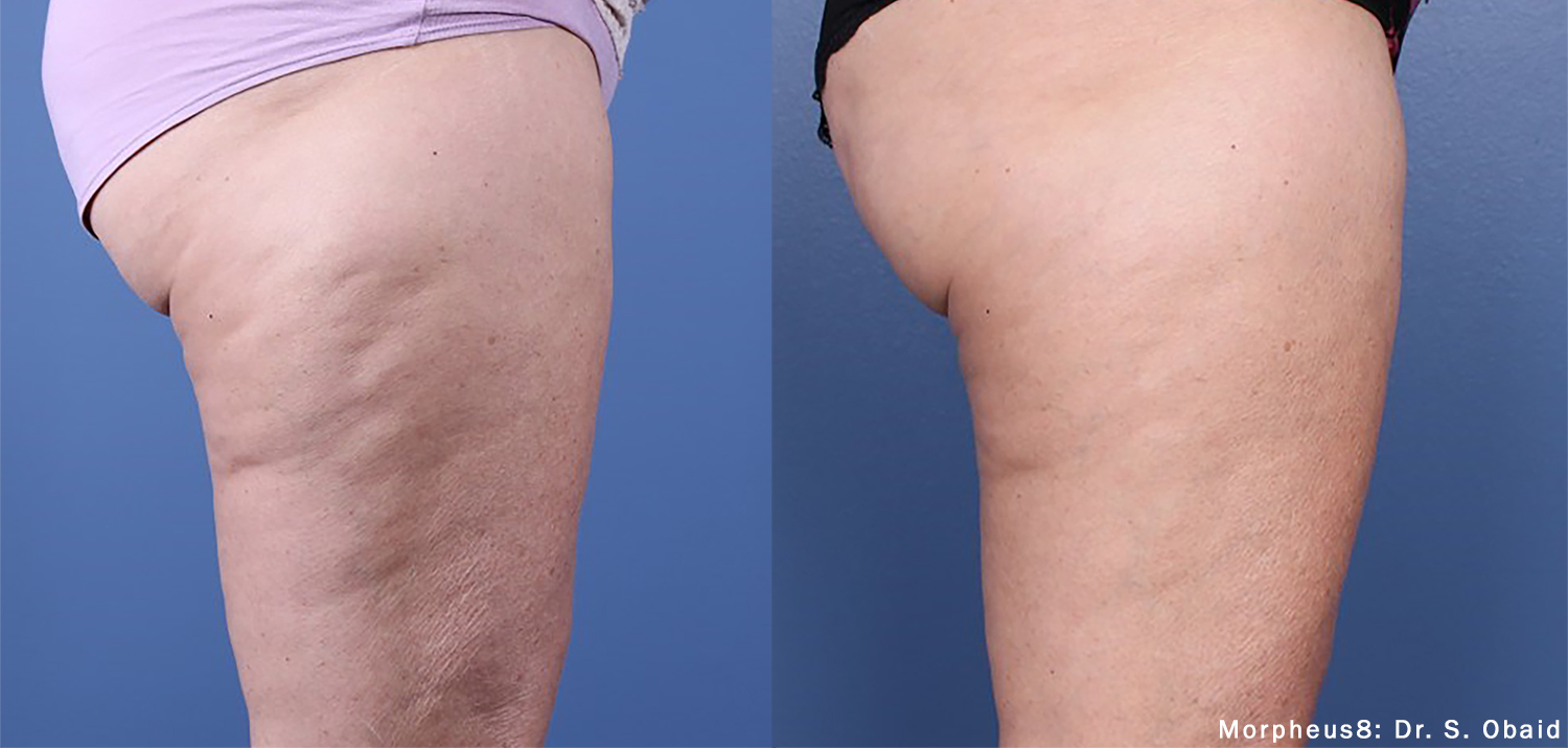 Morpheus8 laser treatment results on woman buttocks and leg area