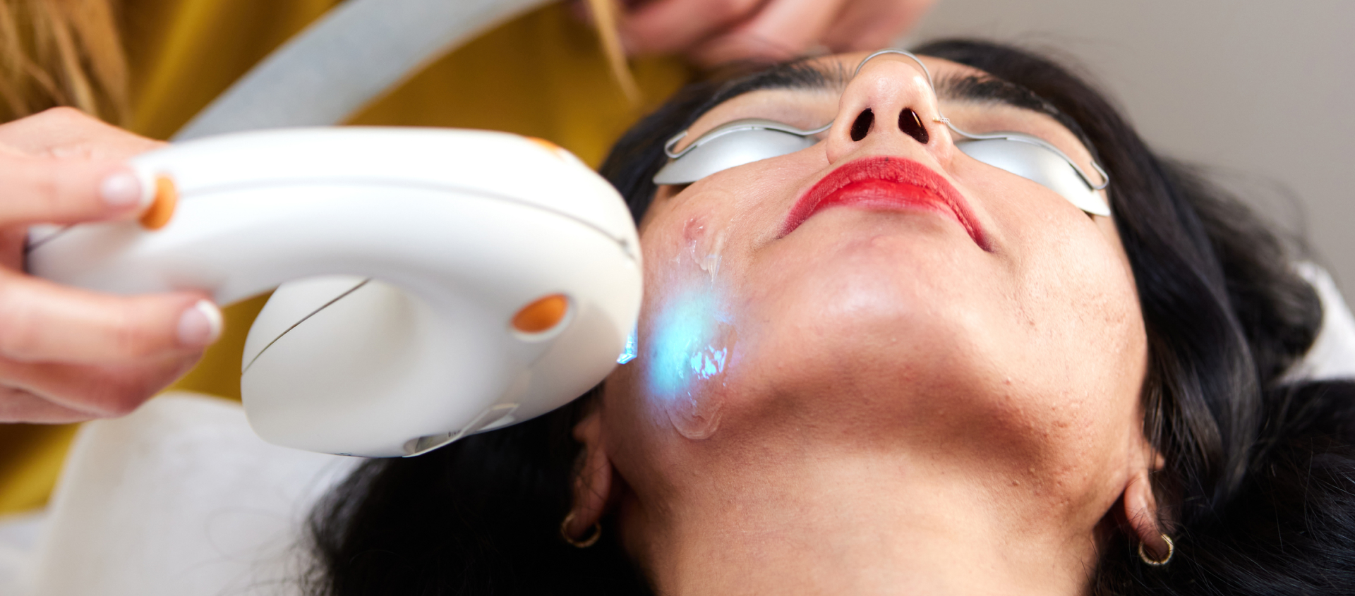 Woman during IPL photorejuvenation solutions for acne session at Alira Med Spa