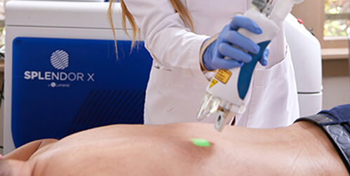 A male client receiving a laser hair removal treatment on his back at Alira Med Spa in Houston.