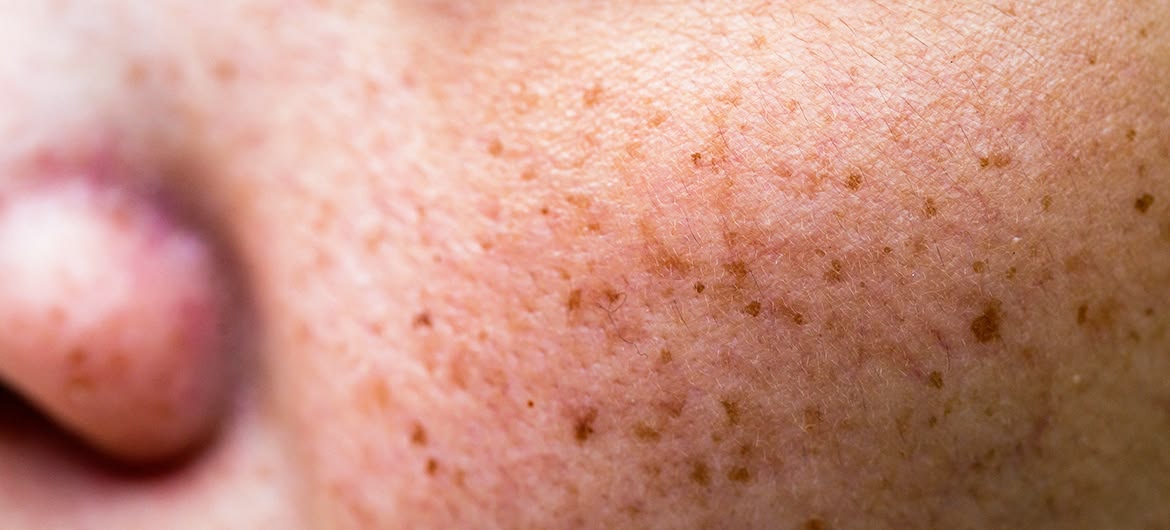 Close-up of facial skin showing sun spots and uneven pigmentation before an IPL photofacial